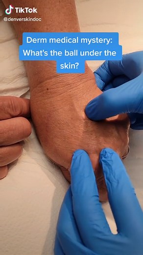 Identifying Skin Condition: White Ball Pimple Under Chin