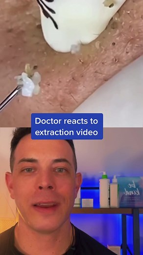 We’re you really gonna eat that? #pimplepopping #extractions #dermatologist #208skindoc