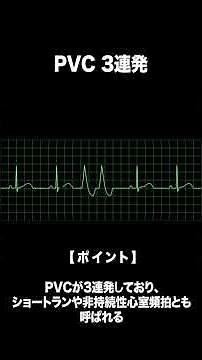 心室期外収縮（PVC）の出現様式