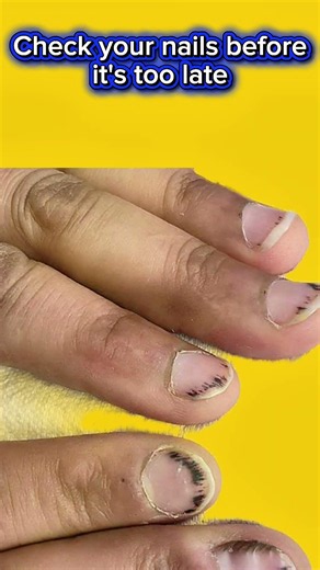 Nail Signs of Heart Disease Every One Must Know Before It's Too Late #healthawareness #hearthealth