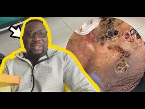 😱 Extreme Jigger Infestation – Flesh Falling Apart! #HG260