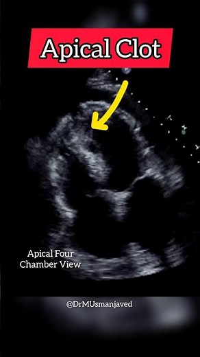 Apical Clot on Echocardiography #heart #echocardiogram
