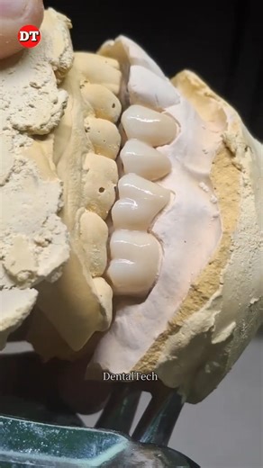 Monolithic Zirconia Posterior Anatomy| Dental technician| laboratory| Exocad| lab | design| zircon