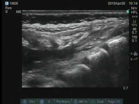 Pediatric Caudal Block.mpg