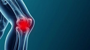 Knee Joint Arthritis Pain Animation