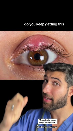 Understanding Chalazions and Styes: Eye Health Explained