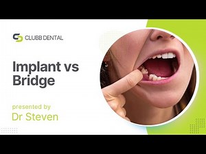 Implant Vs Bridge to replace a missing tooth