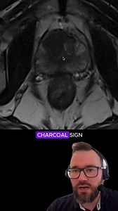 26K views · 254 reactions | Can you recognise prostate cancer on MRI? If you love this teaching by Joe Mullineux, be sure to join our Free Youtube Livestream (in bio) this Friday (April 11, UTC 1600), where he'll be taking us through the essentials of cystic liver lesions! Friday Livestreams are in support of Radiopaedia 2025 (July 21-25), our virtual radiology conference . To find out more, check out the link in our bio. | Radiopaedia.org | Facebook