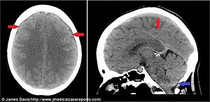 頭痛と片頭痛の診断のためのCTスキャン - 片頭痛 - 頭痛 2026