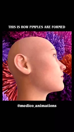 medical_animation on Instagram: "Formation of a Pimple (Pustule) Acne is created when hair follicles become blocked by dead skin cells mixed with sebum. The secretion of normal amounts of sebum by the sebaceous glands prevents the skin and hair from drying out. However, when excessive, this oil can mix with dead skin cells and clog hair follicles and pores. This phenomenon creates an enabling environment to allow bacteria to grow and cause inflammation. When the inflammation is significant, it l