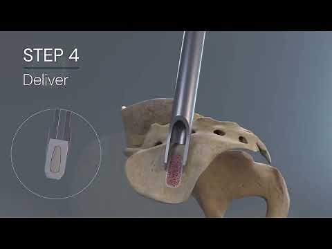 PainTEQ: LinQ Sacroiliac Joint Stabilization and Fusion Procedure