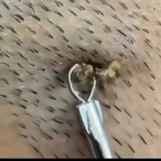 Pimple Content⚠️ on Instagram: "Comment your reaction 🤗 . . - #pimple #pimples #pimplesremover #pimplepop #pimplelife #pimpletreatment #blackheads #blackheadextraction #blackheadremoval"