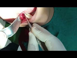 Dentigerous Cyst with Impacted Wisdom Tooth Removal