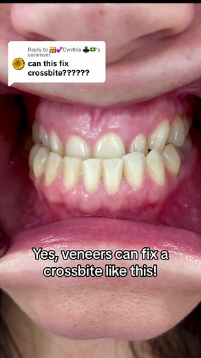 How to Fix Crossbite with Veneers: Expert Tips and Techniques