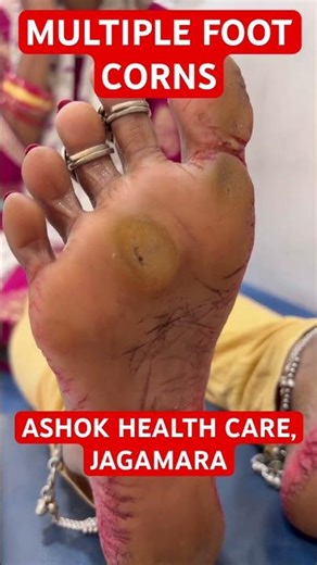 #footcorn #shorts #footcornremoval #ashokhealthcare #jagamara