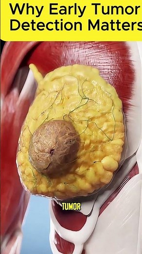 How quickly breast tumors can develop. #breastcancer #awareness #facts