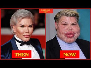 30 Plastic Surgery Disasters You Won't Believe Happened | Then and Now Photos 2026