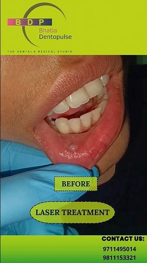 MUCOCELE Removal with Dental Laser: Dr. Srishti Bhatia #laser #mucocele #painlessdentistry