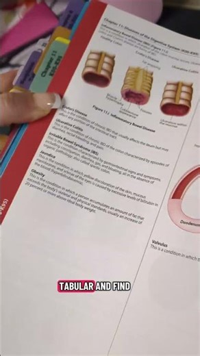 How to find the ICD-10-CM code for acute appendicitis