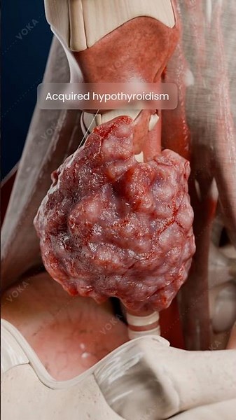 Acquired Hypothyroidism in 3D: Causes, Symptoms & Lifelong Treatment