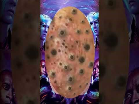 Blackheads Removal #152 | Acne Treatment and Very Satisfying Satisfying Pimple pop #blackheads