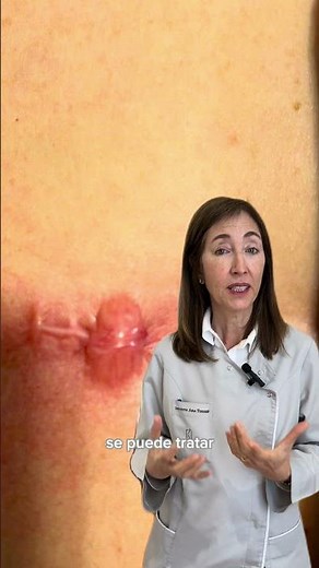 ¿Qué es un queloide? - Instituto Dra. Ana Torres Barcelona