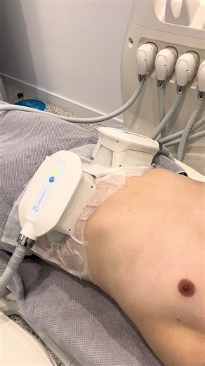 Want results? Cryolipolyis targets your stubborn areas. #fyp #viral #fypage