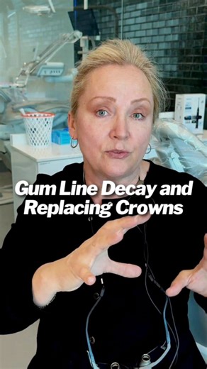 👑 Discover why replacing a crown is vital!When decay breaches the seal, bacteria infiltrate, causing complications. Treatment involves removing the tooth and crafting a new crown.😟Let's dive deeper into dental care: Decay manifests as darkening areas and stickiness when probed.Prioritizing gum health is crucial before crown replacement to ensure a successful outcome. In the end, a healthy smile awaits!😄🌟Follow me for more dental insights! 🦷💡#naturaldentistry #dentalcareworld #oralcaretips 