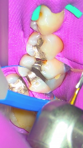 Amalgam Removal Techniques for Dental Students