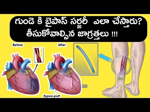 Coronary Artery ByPass Graft surgery(Animation video)/CABG/telugu