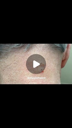 Sandra Lee, MD, FAAD, FAACS on Instagram: "Love it when you call big poppa #drpimplepopper"