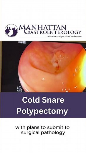 Precision in Practice: Cold Snare Polypectomy Procedure 🔬 Watch this advanced technique.