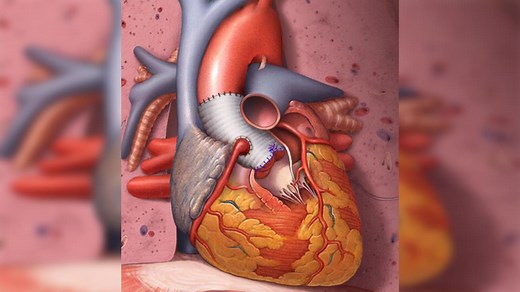 Interviews with the experts: The David procedure - Mayo Clinic