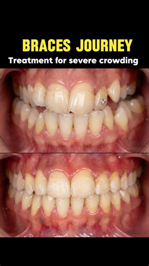 Severe crowding fixed! Amazing braces journey 🦷 #braces #orthodontics #smilemakeover