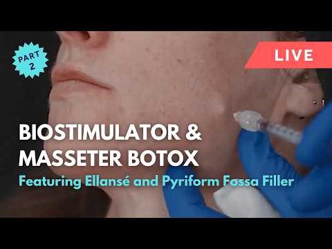 GEM© Clinic 💎 Live Ellansé Biostimulator, Pyriform Fossa & Masseter Botox (Charlotte, Part 2)