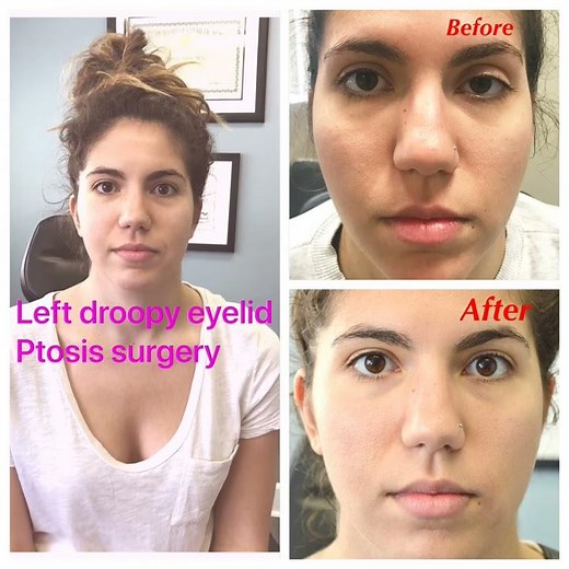 Scarless Congenital Droopy Upper Eyelid Ptosis Surgery in a young woman.