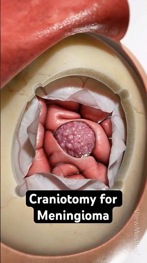 Removing a brain tumor (3D Animation)