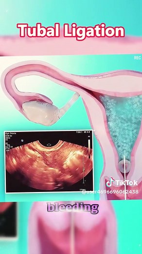 Understanding Tubal Ligation: The Laparoscopic Procedure