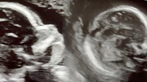 2 babies, 2 separate pregnancies: Alabama woman born with double uterus pregnant in both