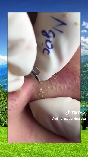 Pimple Satisfying on TikTok