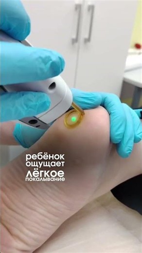 Удаление бородавок детям