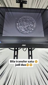 MCDA: kembar seiras Monochorionic Diamniotic twins, a type of pregnancy where genetically identical twins share a single placenta but have separate amniotic sacs. This condition is always a result of monozygotic (identical) twins, typically formed from a single fertilized egg splitting later in development. Berlaku antara 1- 3% dlm rawatan ivf Sememangnya rezeki Namun MCDA pregnancy mempunyai risiko lebih kepada ibu dan bayi yg di kandung Keep it up ttc 💪💪💪 | Dr Salleha Khalid