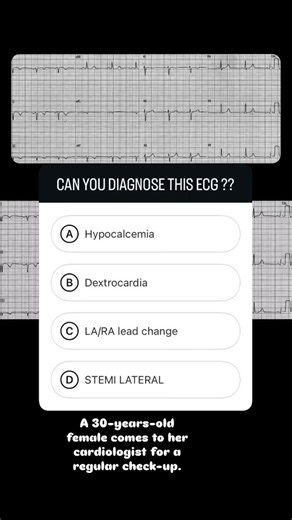 Mastering in ECG on Instagram: "Ecg quiz . . . #ecg #nursing #ecgchallenge #nursing #ecginterpretation #cardiology #ecgreading #medicine #cardiovascular #ecglovers #nursingstudent"