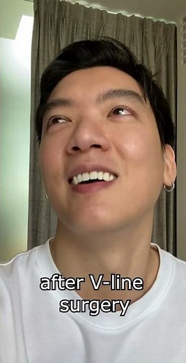 V-LINE surgery gives you a more defined face structure 💀