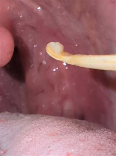 #asmr #tonsiliths #tonsilstones #mouth | tonsil stones