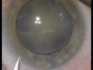 Intumescent white cataract surgery