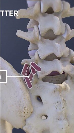Ever wondered how surgeons stabilize the spine at the L5-S1 level to relieve chronic back pain?