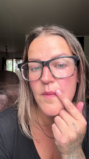 1.5 year update on my monroe piercing scar revision #scarrevision #monroepiercing #dermatologist #scar #facepiercing #scar