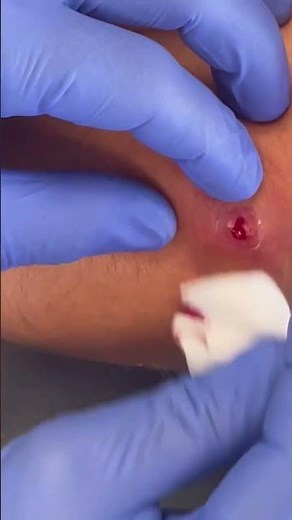 Draining a staph infection isn’t just about squeezing—proper technique is key for full healing
