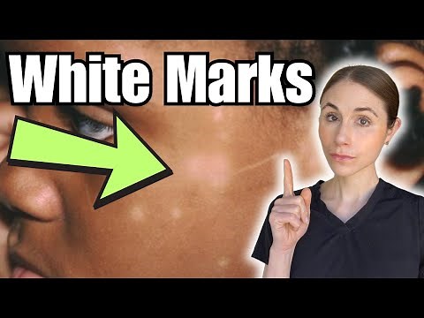 White Marks On The Skin | Hypopigmentation Causes And Treatment